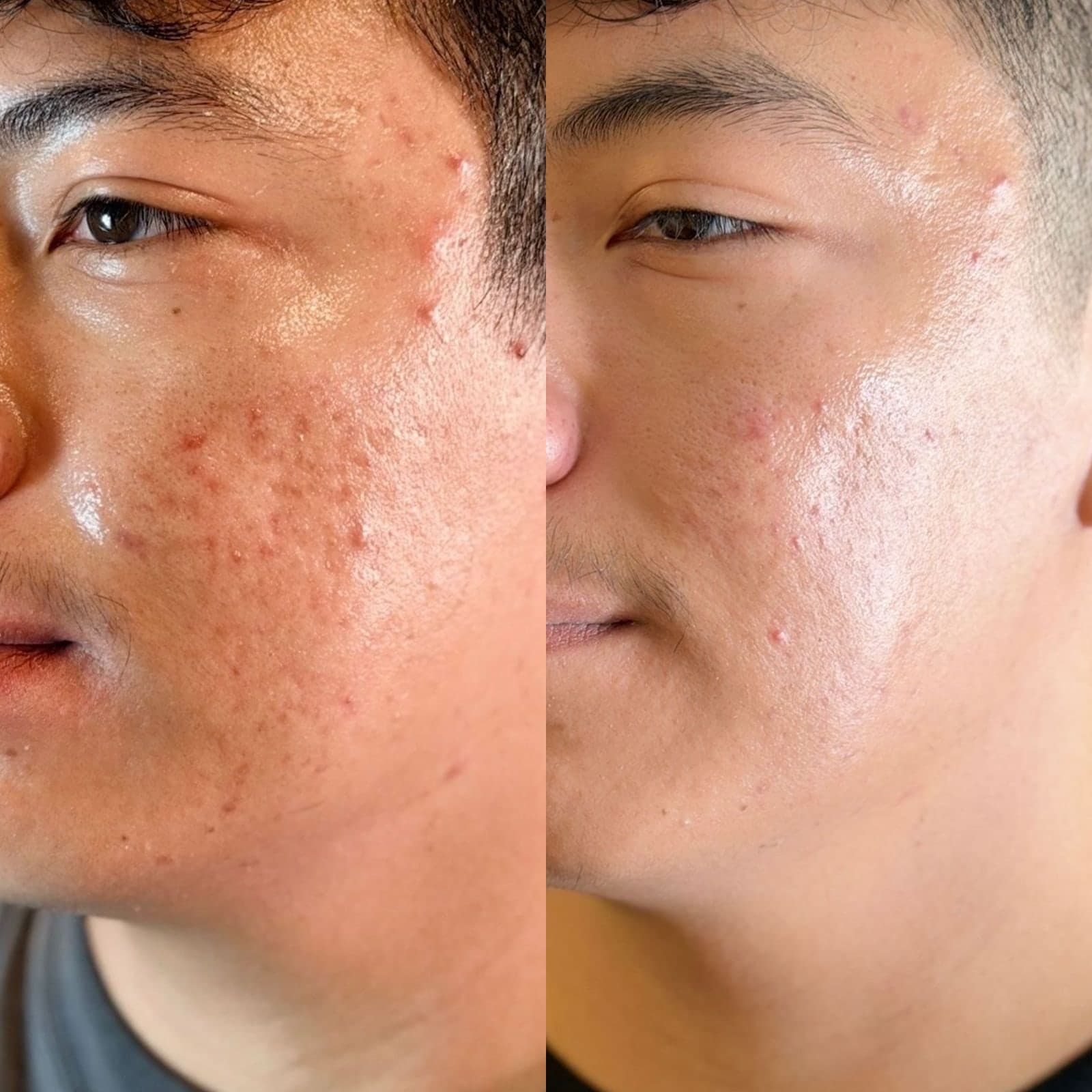Acne management before and after, right cheek (three-quarter view) — active cheek breakouts calmed and skin noticeably clearer after an individualized skincare and prescription-therapy plan, Lancaster, PA