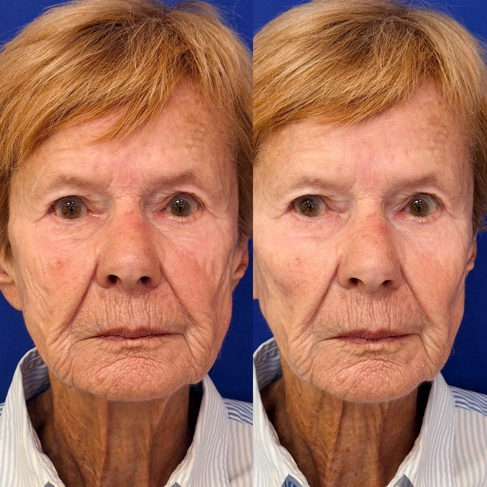 Dermal filler before and after, front view — natural full-face balancing with restored midface volume and softened lines, Lancaster, PA