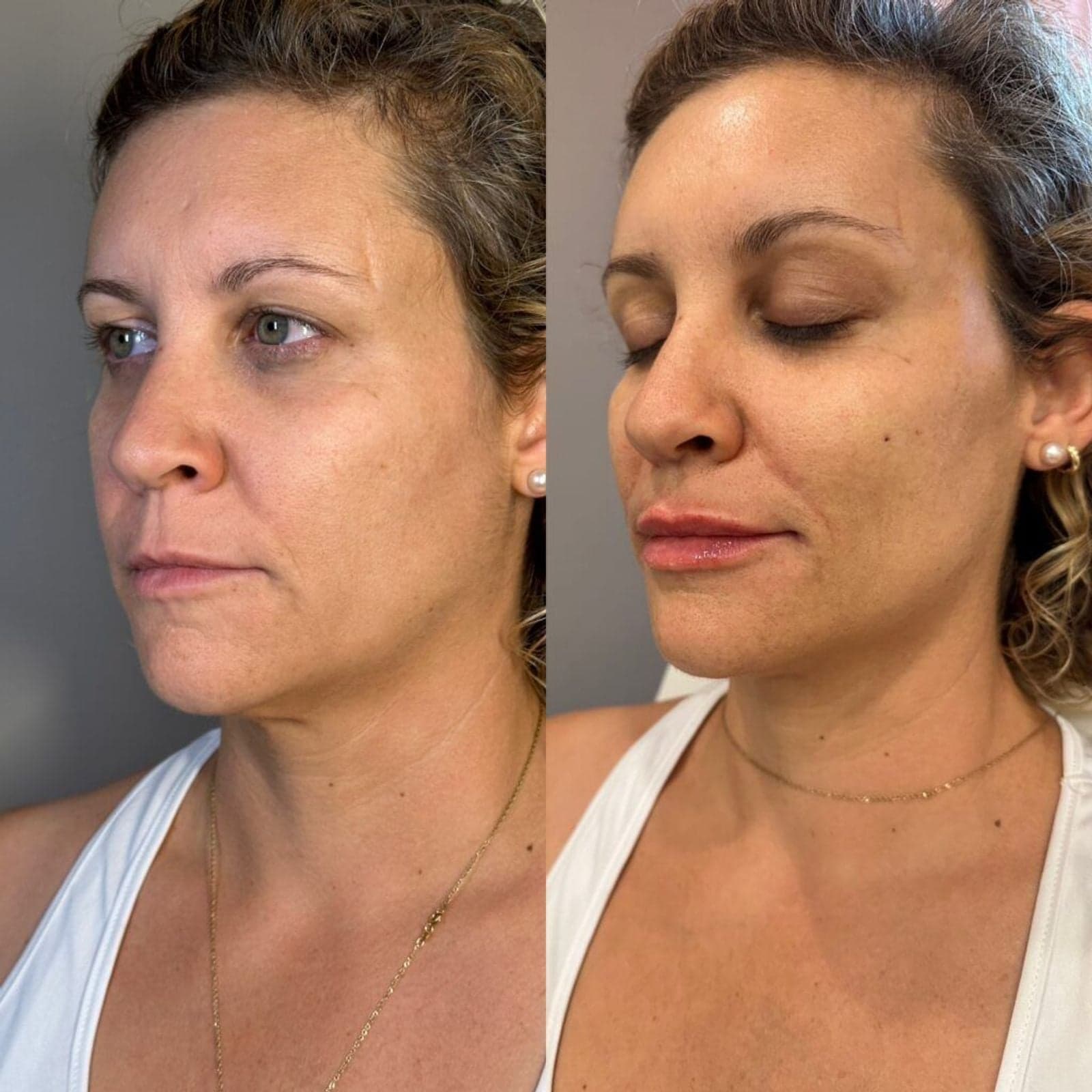 Facial balancing before and after, left three-quarter view — refined proportions and softened lower face with filler and neuromodulator, Randali, Lancaster, PA