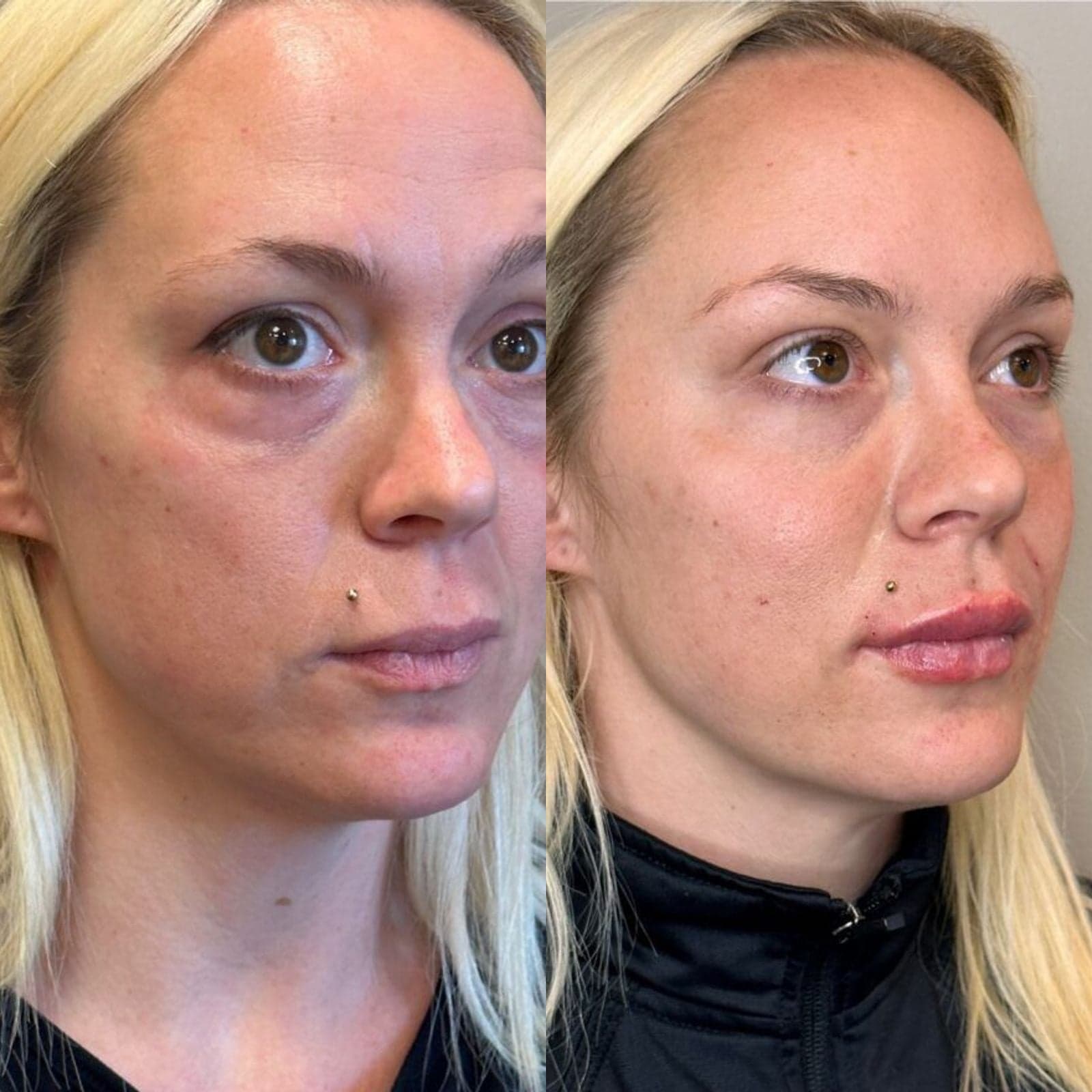 Facial balancing before and after, right three-quarter view — refreshed under-eyes and balanced features with filler and neuromodulator, Randali, Lancaster, PA