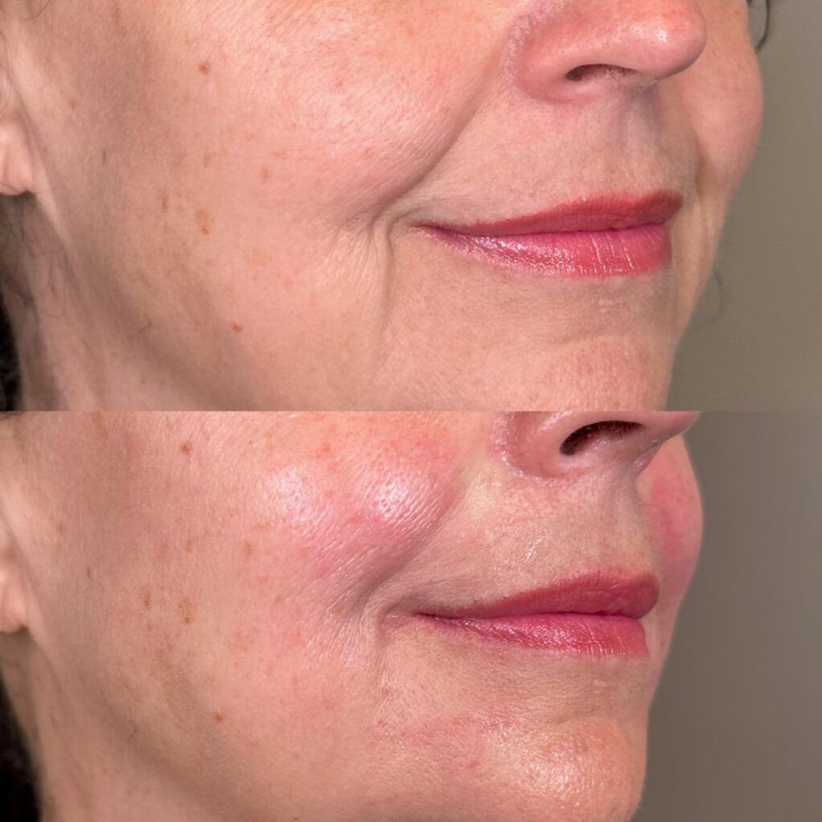 Dermal filler before and after — softened nasolabial folds and marionette lines for a smoother lower face, Randali, Lancaster, PA