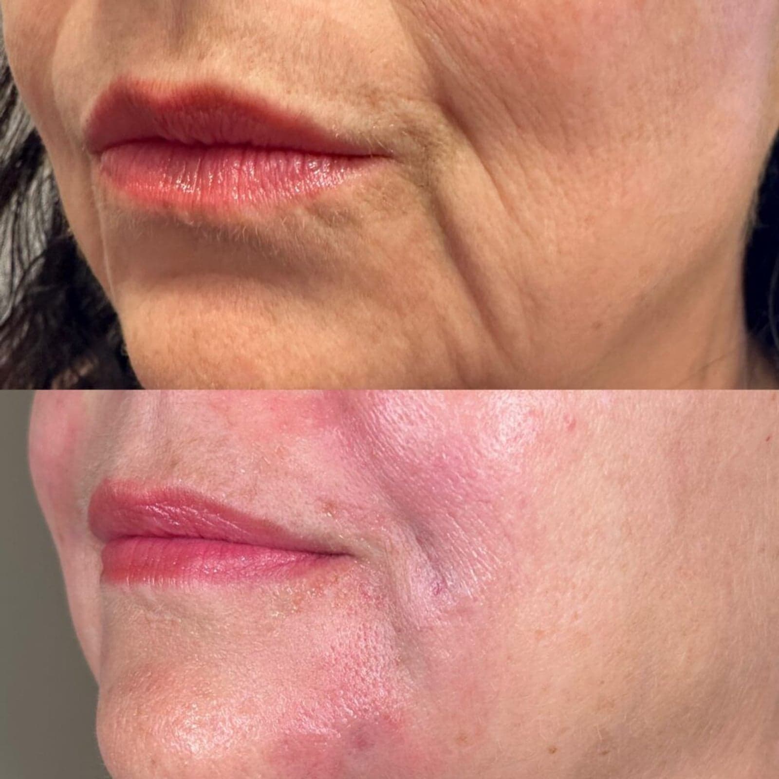 Dermal filler before and after — softened a deeper nasolabial fold and marionette line for a smoother, more rested look, Randali, Lancaster, PA