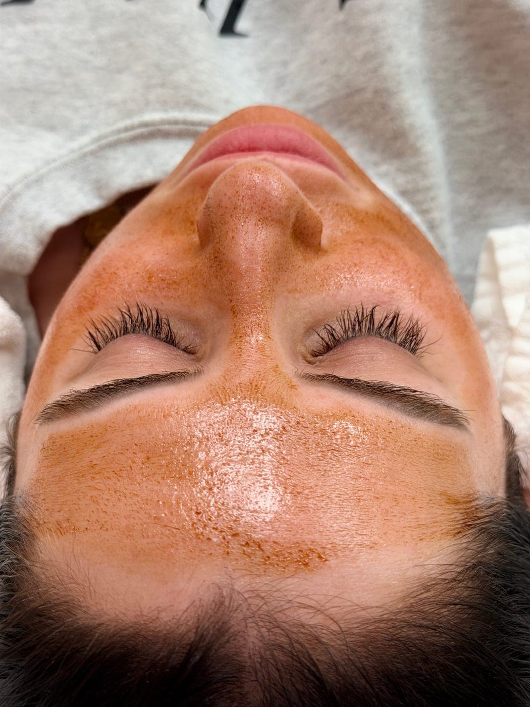A peel solution applied evenly across a patient's skin during treatment at Randali in Lancaster, PA.