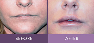 Dermal Fillers | Randali Centre for Aesthetic Medicine